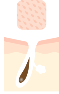 たるみ毛穴のイラスト