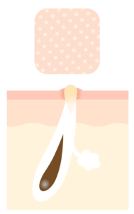 詰まり毛穴のイラスト