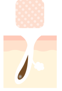 開き毛穴のイラスト